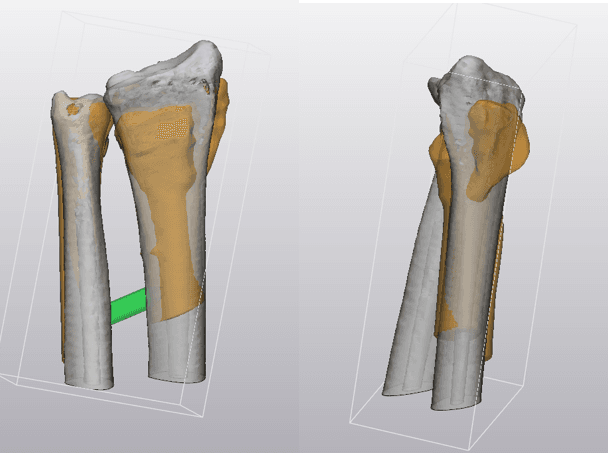 Distal Radius Malunion Corrective Osteotomy: 01. AP, Lateral and axial views