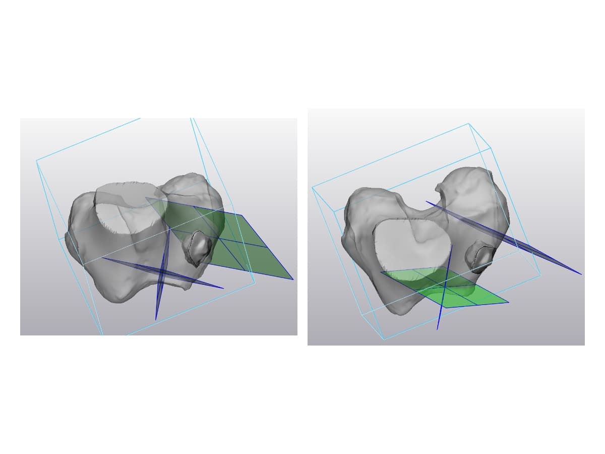 Distal Femoral Resection & Saw Slot Capture: 01. Axial Cut Planes