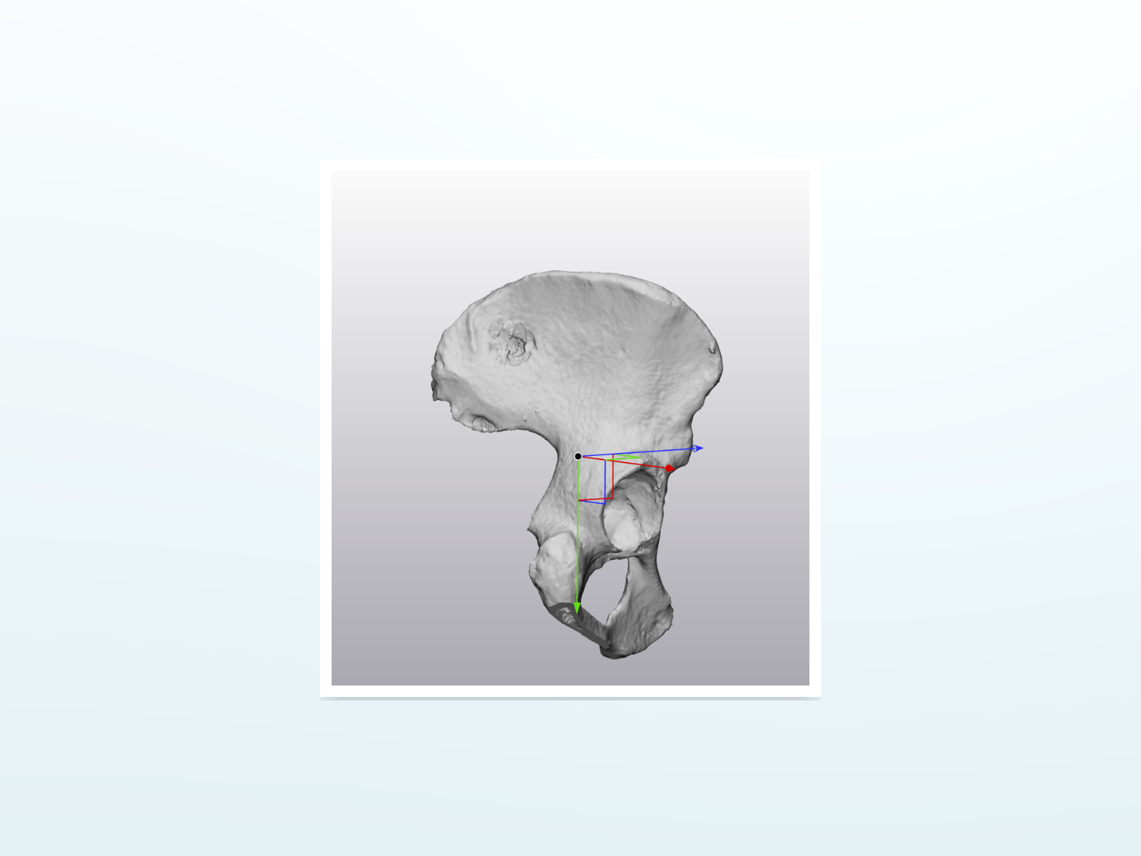 Internal Hemipelvectomy & Sacral Ala Resection: 01. Preoperative Hemipelvis CT Model