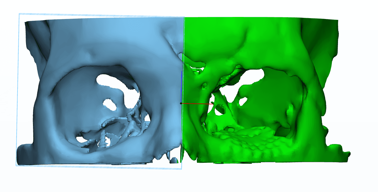 Supraorbital Ridge & Orbital Floor Trauma Reconstruction: 01. Native Bilateral Orbital Anatomy